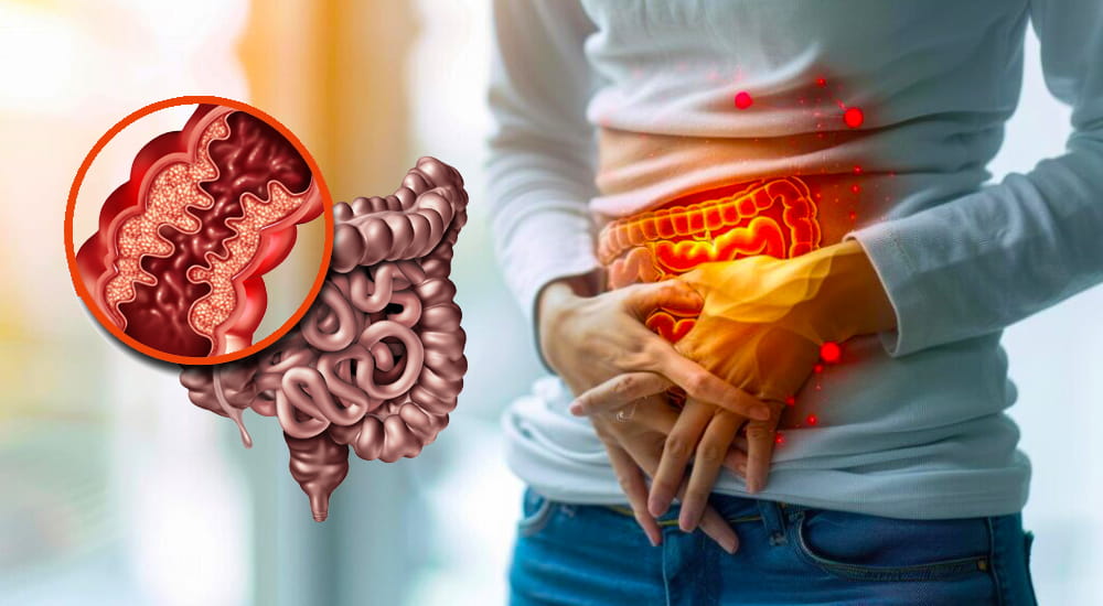Crohn’s Disease : Symptoms and risk factors